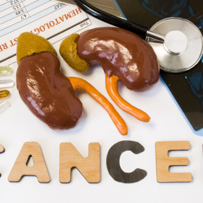 Screenings and Treatments for Kidney Cancer