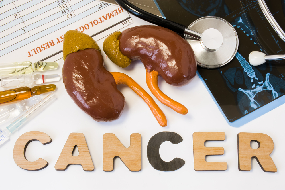 Screenings and Treatments for Kidney Cancer