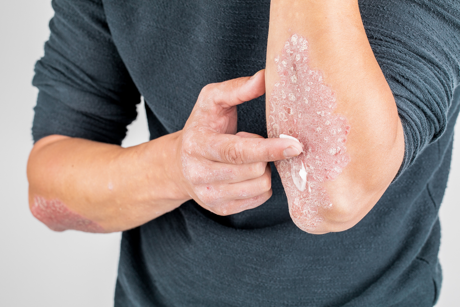 6 Health Conditions Linked to Psoriasis