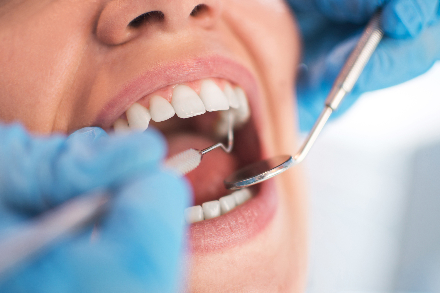 Dental Implant Cost: Instant Ways to Save on Dental Implants